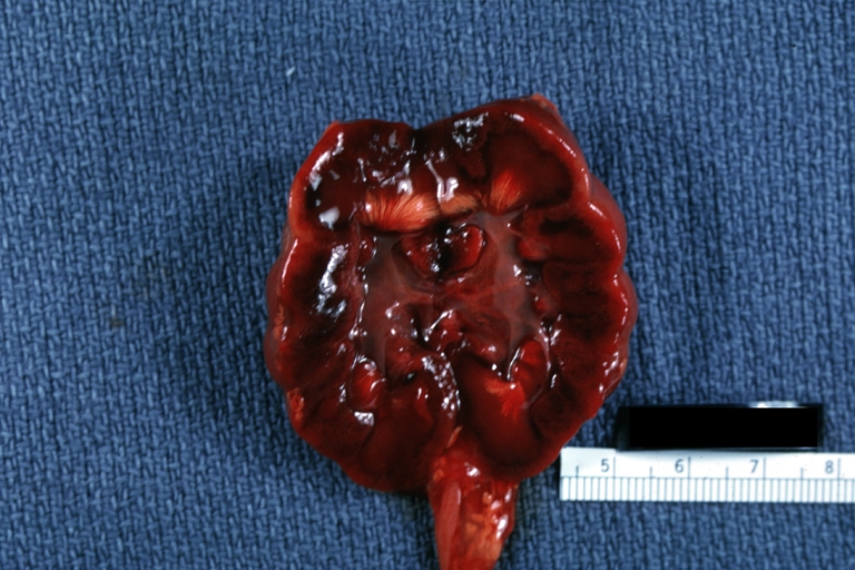 Kidney: Uric Acid Infarcts: Gross natural color typical lesion well shown