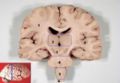 Human brain frontal (coronal) section