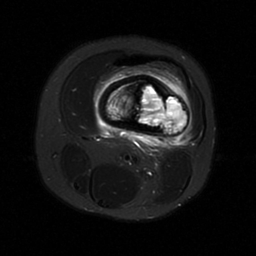 File:Osteosarcoma-distal-femur (4).jpg