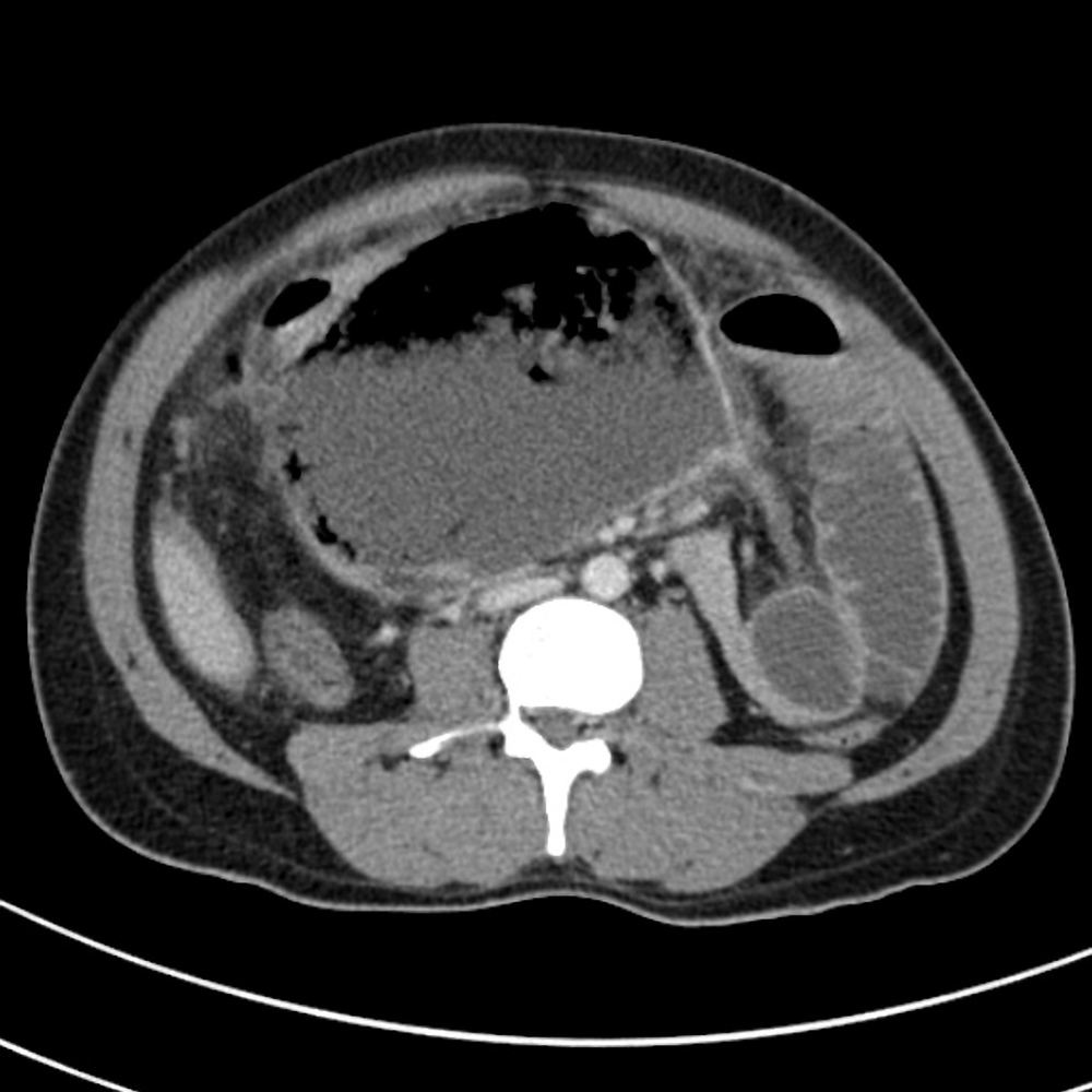 Intestinal perforation CT, source: Case courtesy of Dr Ian Bickle, Radiopaedia.org, rID: 47152