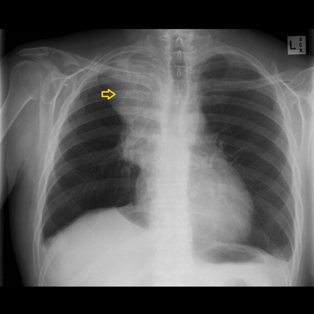 File:Small cell Lung CA.jpg