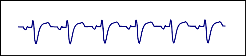 Atrial tachycardia - like sinustachycardia but the p wave has a different morphology