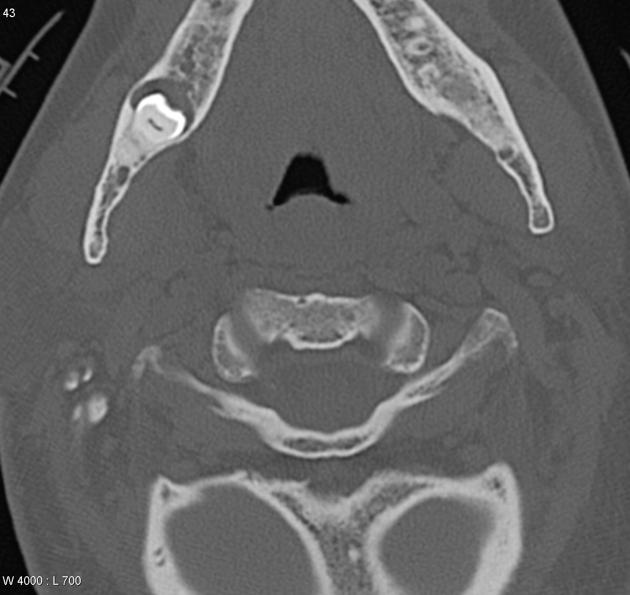 File:Axial bone window dentrigerous cyst.jpg