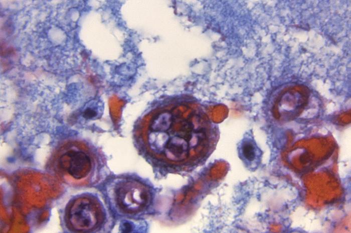 Photomicrograph reveals some of the cytoarchitectural histopathologic changes which you’d find in a human skin tissue specimen that included a chickenpox, or varicella zoster virus lesion (1200x mag). From Public Health Image Library (PHIL). [1]