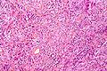 A smear showing meningothelial meningioma HPS stain