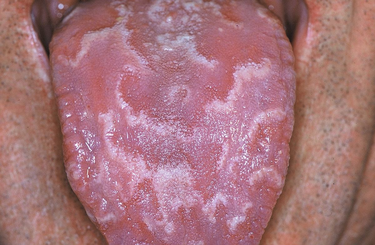 File:Geographic tongue 01.JPG