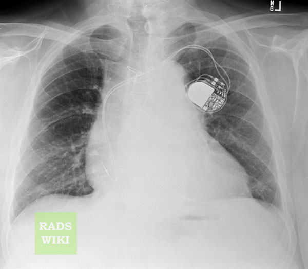 Chest x-ray: Pericardial effusion