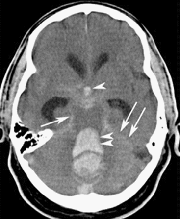 File:Stroke CT02.png