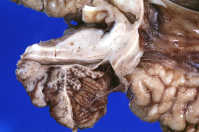 Brain: Arnold Chiari Malformation: Gross fixed tissue sagittal section brainstem close-up