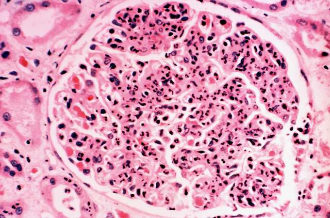 This is a photomicrograph of a glomerulus from another case with acute poststreptococcal glomerulonephritis. In this case the immune complex glomerular disease is ongoing with necrosis and accumulation of neutrophils in the glomerulus.