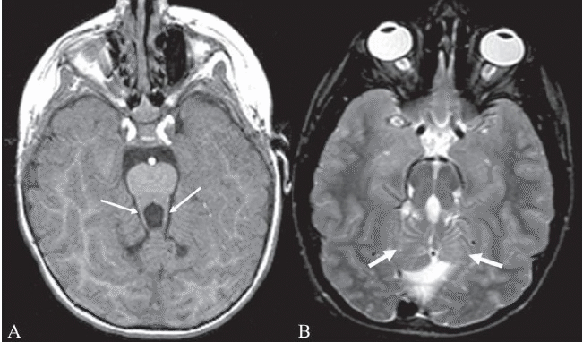 File:Molar tooth sign and hypoplasia of the cerebellar vermis in Joubert syndrome.gif