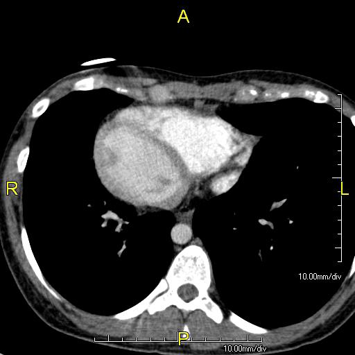 Axial CT image showing dextrocardia with the IVC and morphologic right ventricle on the left and the left ventricle on the right