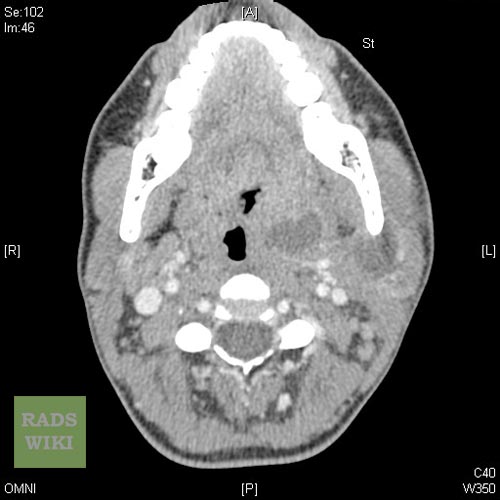Peritonsillar abscess Image courtesy of RadsWiki and copylefted