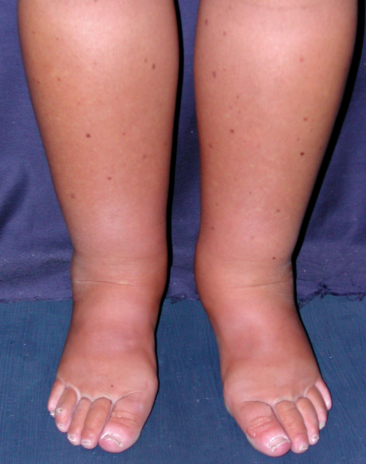 File:Primary intestinal lymphangiectasia (Waldmann's disease) - legs.jpg