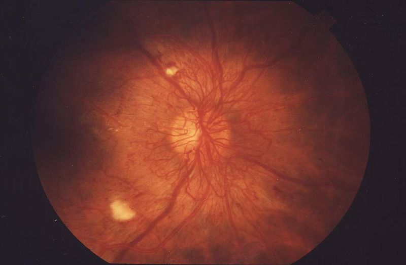 File:Proliferative retinopathy.JPG