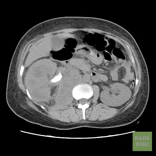 CT image demonstrates right xanthogranulomatous pyelonephritis