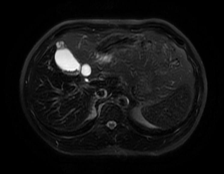 File:Adenomyomatosis MRI 004.jpg