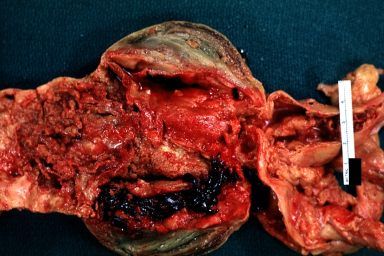Atherosclerotic Aneurysm: Gross, (rather) good example of abdominal aortic aneurysm