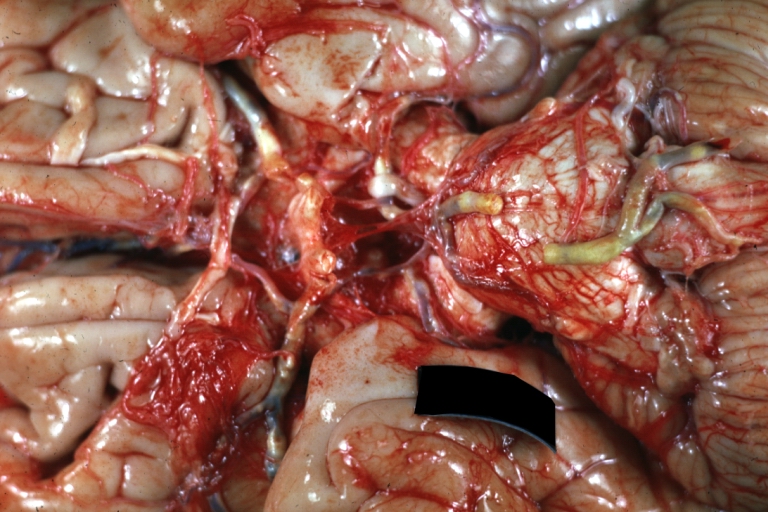 Brain: Atherosclerosis: Gross, a good example of atherosclerosis in vessels at base of brain.
