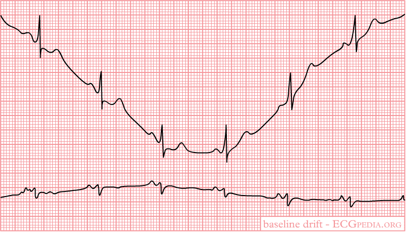 Baseline drift. The amplifier in the ECG machine has to re-find the 'mean'. This often occurs right after lead connection and after electric cardioversion.