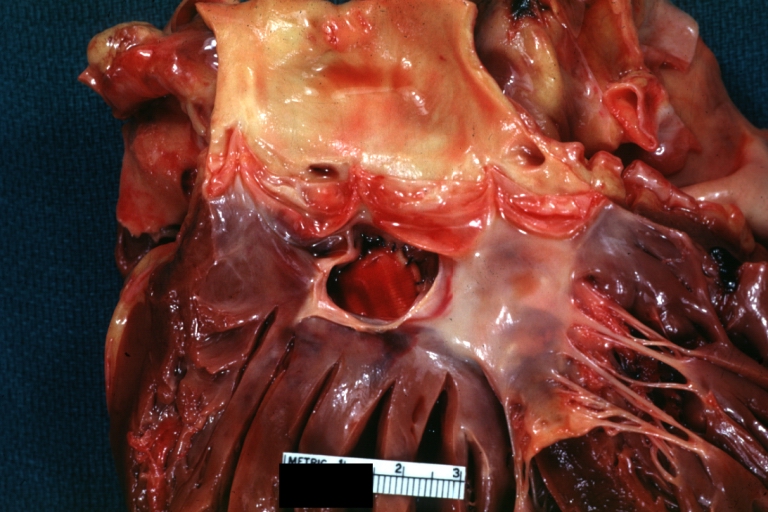 Tetralogy of Fallot: Gross, a good example of repaired perimembranous septal defect