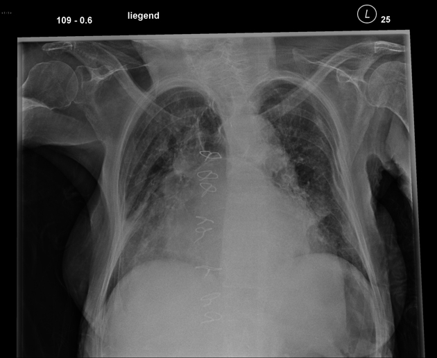Aside from the dirty lung due to emphysema and pneumonic infiltration in the lower right field you can notice a marked enlargement of the left atrium with splaying of the carina.