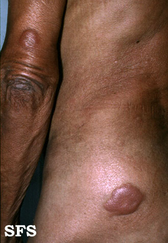 File:Lepromatous leprosy20.jpg