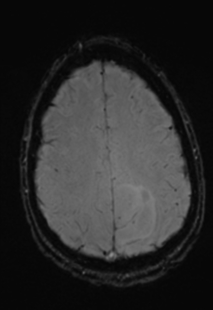 A sharply defined zone of abnormal slightly heterogeneous signal in the left parietal lobe extends to involve the medial cortex of the superior parietal lobule. Inferiorly it abuts and distorts the cingulate gyrus. Superiorly it is significantly posterior to the precentral gyrus and slightly posterior to the left post central gyrus. Posterior and laterally it extends to and distorts the left intraparietal sulcus. It extends to within 1 cm of the parieto-occipital fissure postero-medially, slightly posteriorly bowing it. It exhibits no restricted diffusion and no pathological contrast enhancement.[5]