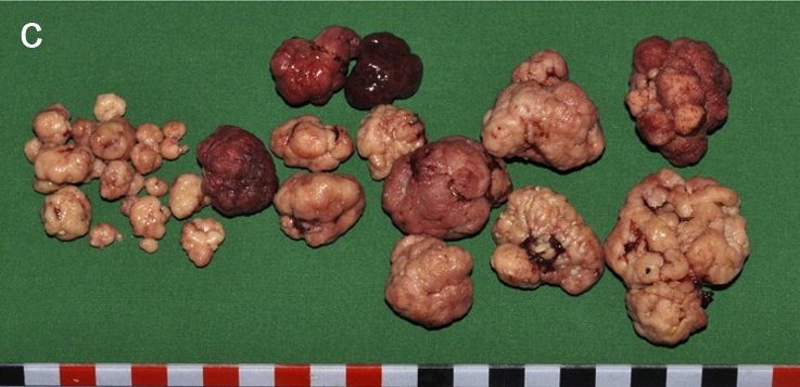 Resected polyps of different sizes.