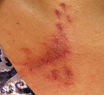 Paederus dermatitis. With permission from Dermatology Atlas.[9]