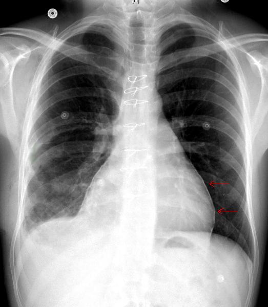 File:Pericardial calcification.jpg