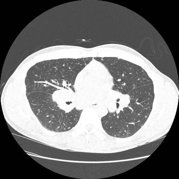 File:Perilymphatic solitary pulmonary nodules.jpg