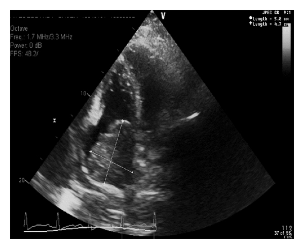 A comprehensive 2 dimensional M-mode color flow and Doppler echocardiography reveals a normal left ventricular systolic function (EF 60–69%). A large right atrial mass measuring  cm almost fills the right atrium and extends into the tricuspid valve causing tricuspid regurgitation.[16]