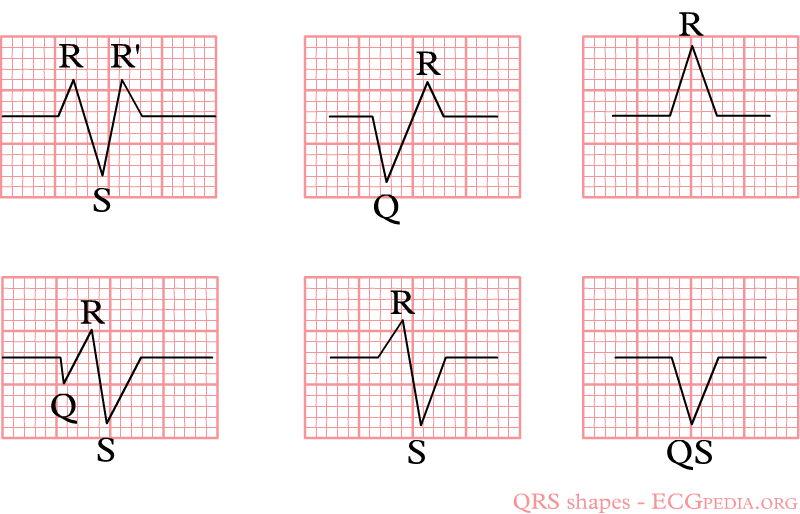 Example of the different QRS configuations