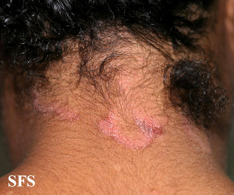 File:Seborrhoeic dermatitis 14.jpeg