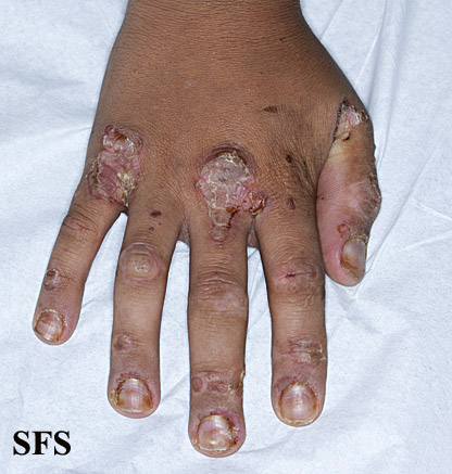 url = http://www.atlasdermatologico.com.br/disease.jsf?diseaseId=505>