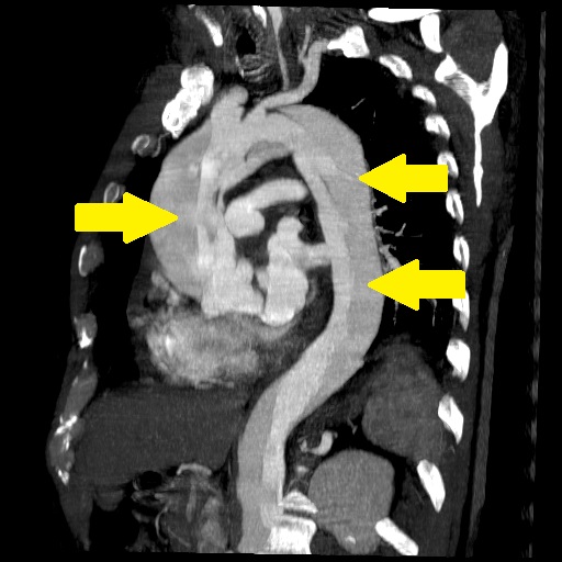 File:Aortic-dissection-debakey-type-1.jpg