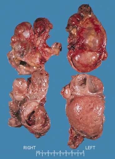 Bilateral pheochromocytoma in MEN2. Gross image, source: By AFIP Atlas of Tumor Pathology - [1], Public Domain, https://commons.wikimedia.org/w/index.php?curid=4288117