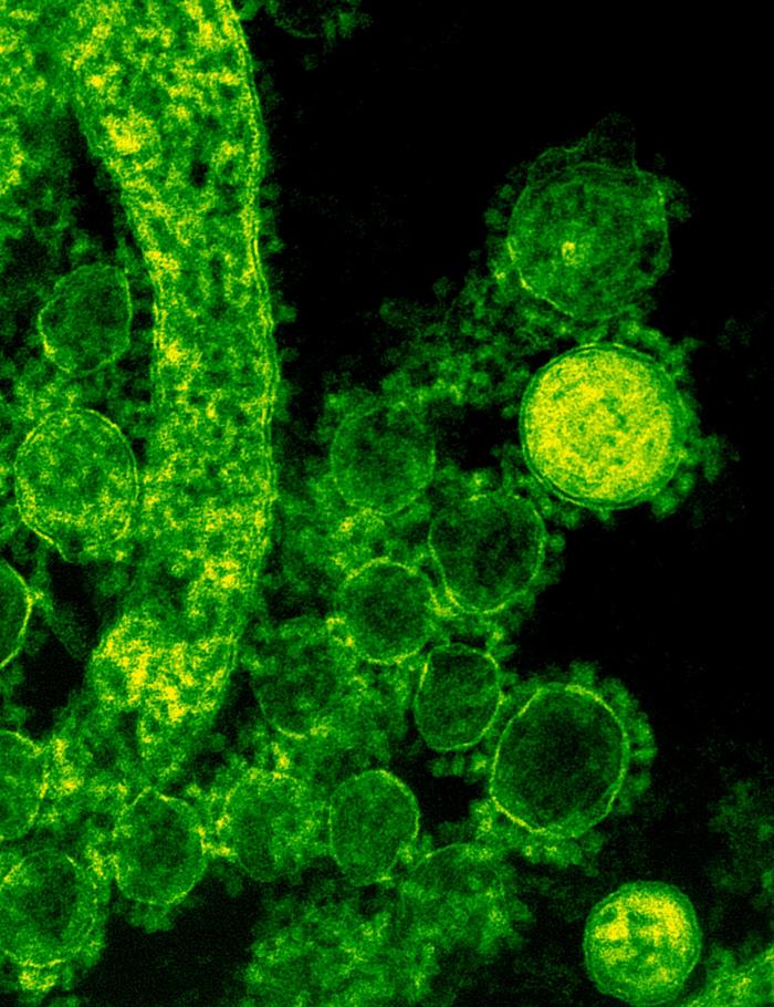 TEM reveals ultrastructural details exhibited by a number of spherical-shaped Middle East Respiratory Syndrome Coronavirus (MERS-CoV) virions. From Public Health Image Library (PHIL). [6]