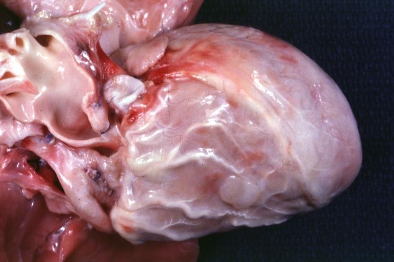 Coronary Artery Anomalous Origin Left from Pulmonary artery: Gross natural color anterior view of hear showing large marginal type branches over anterior right ventricle 5 month old infant died after operation switching artery to aorta