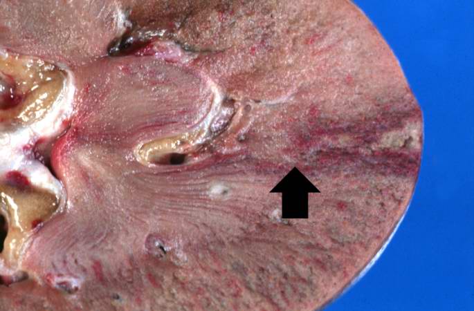 This gross photograph of an infarcted kidney is from another case. The triangular shape of an infarct is prominent on the right side of the image; the apex (arrow) of the triangle is evident at the corticomedullary junction.