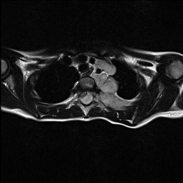 Neuroblastoma observed on transverse MRI as a large mass which extends into the spinal canal and causes significant cord compression[4]