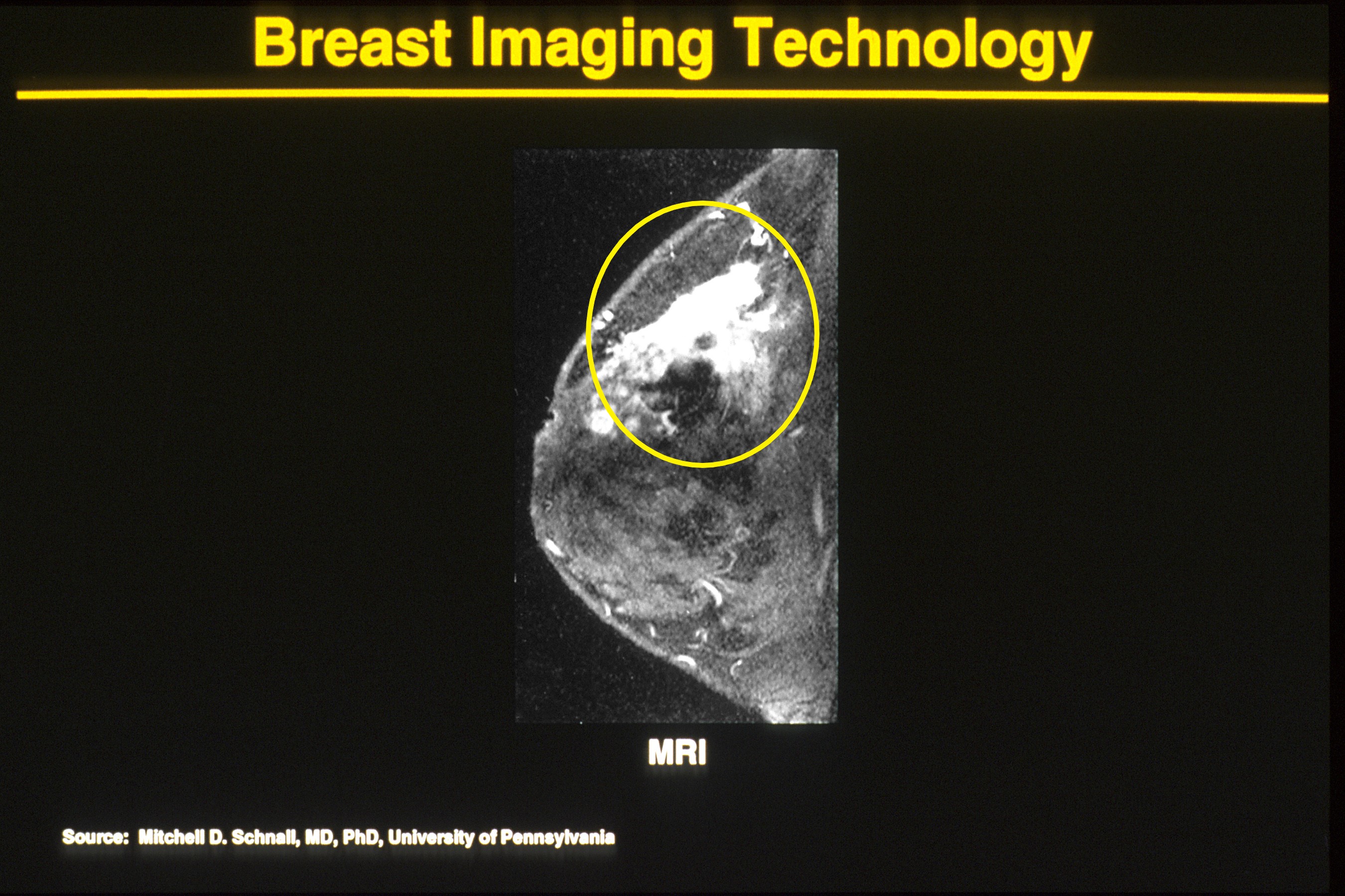 File:Mri of breast cancer.jpg