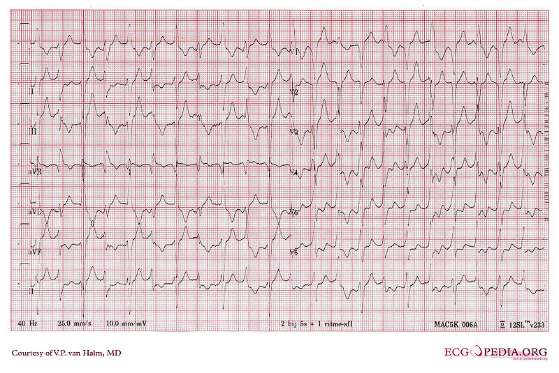 File:Ventricular Tachycardia 3.jpg