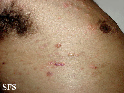 Bullous pemphigoid. Adapted from Dermatology Atlas.[1]
