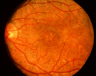 "salt and pepper" retinopathy is the most common ocular manifestation of CRS. Adapted from https://commons.wikimedia.org/w/index.php?title=Special:Search&profile=default&fulltext=Search&search=congenital+rubella&uselang=en&searchToken=8w4tgh0h9d3qa8wfbhn0r0z6z#/media/File:Congenital_Rubella_Syndrome,_Salt_and_Pepper_Retinopathy.jpg. Accessed on Jan 16, 2017