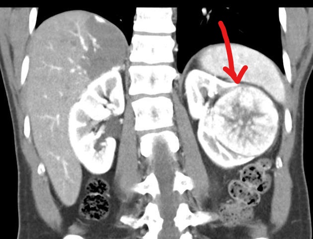 File:Coronal contrast CT of renal oncocytoma.jpg