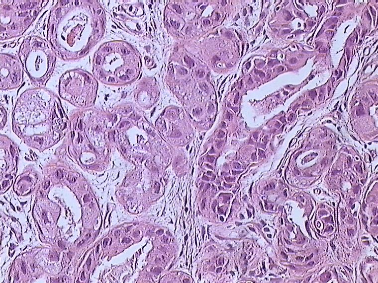 Breast cancer (Infiltrating ductal carcinoma of the breast) dyed with H&E