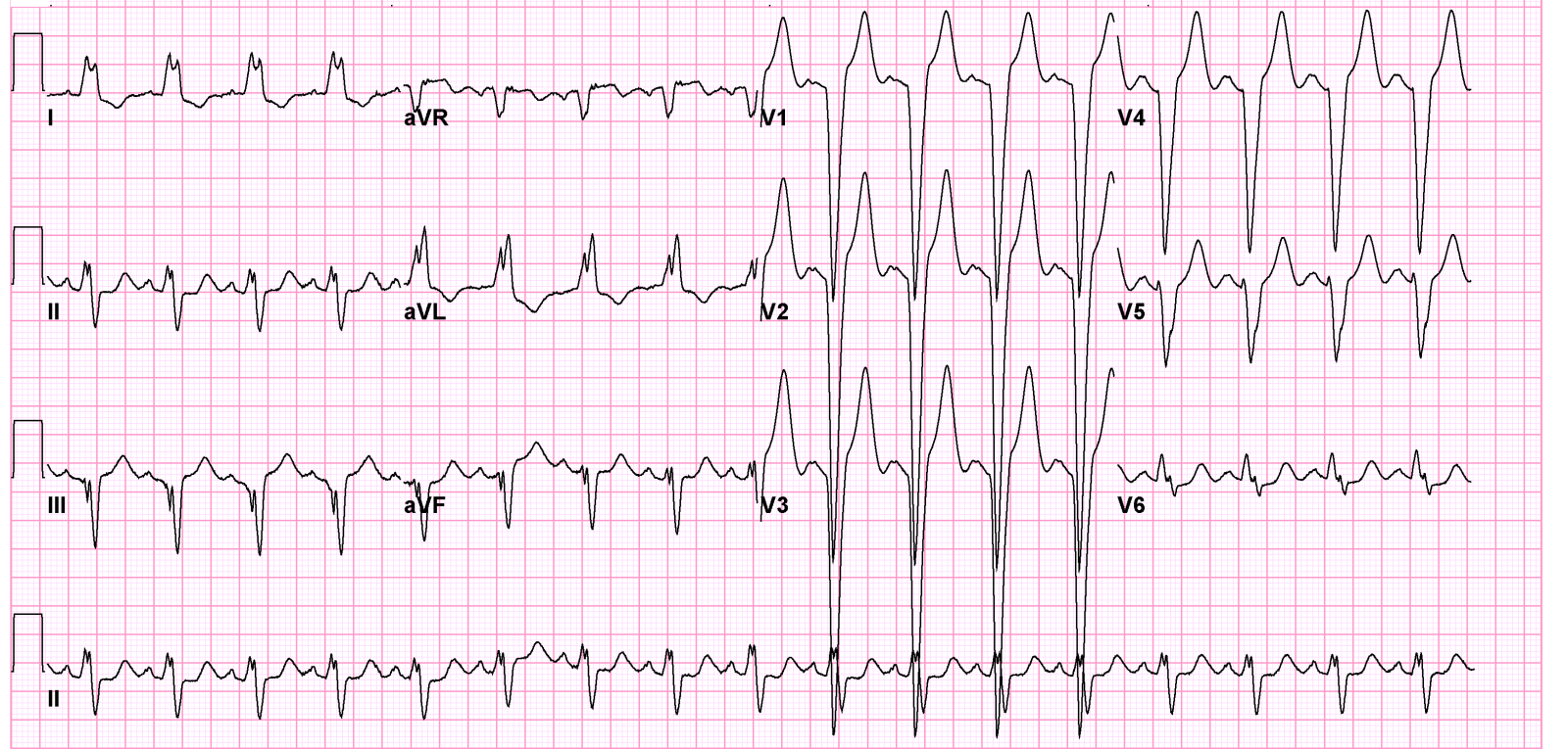 File:LBBB01.png