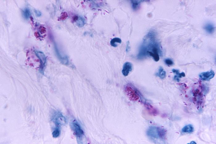 Light photomicrograph revealing some of the histopathologic cytoarchitectural characteristics seen in a mycobacterial skin infection Adapted from Public Health Image Library (PHIL), Centers for Disease Control and Prevention.[23]
